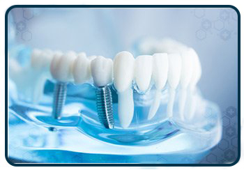 Implants Dentaires